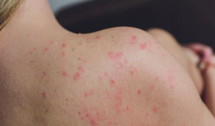 蕁麻疹發作區域 蕁麻疹發作區域