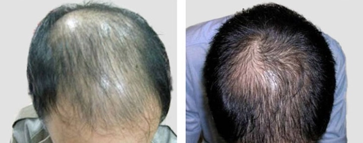 掉髮保健品 掉髮保健品