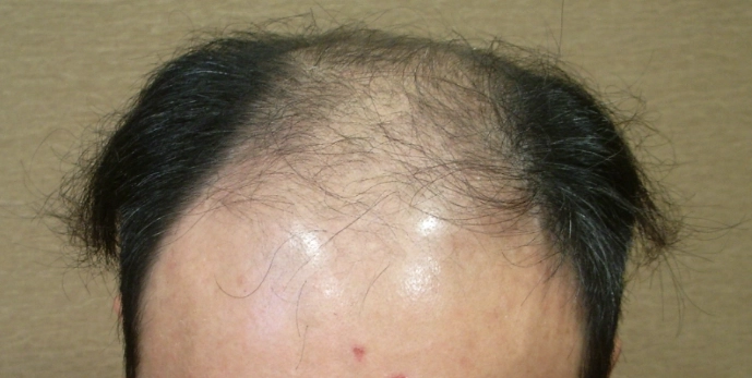 掉髮治療 掉髮治療