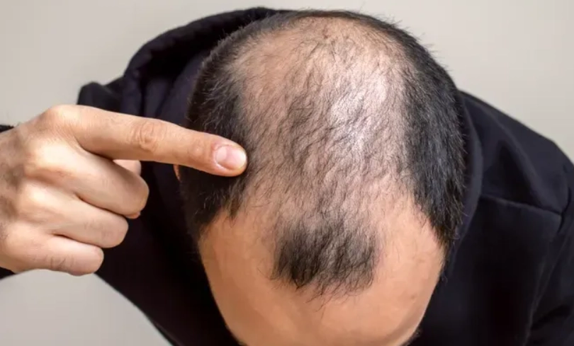 掉髮原因 掉髮原因