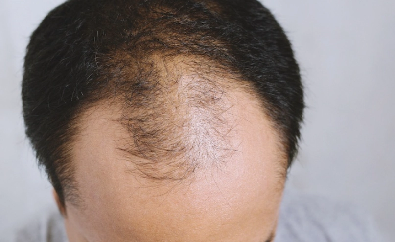 雄性禿原因 雄性禿原因