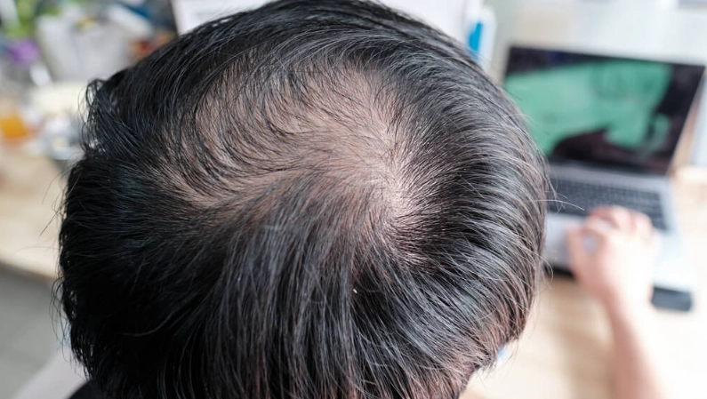 雄性禿原因 雄性禿原因