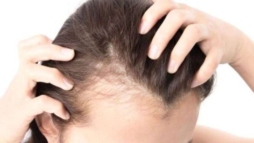 髮量稀疏怎麼辦 髮量稀疏怎麼辦
