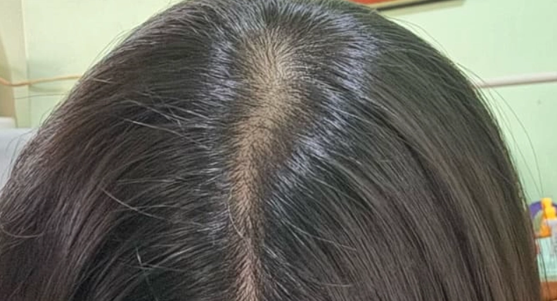 女生掉髮標準 女生掉髮標準