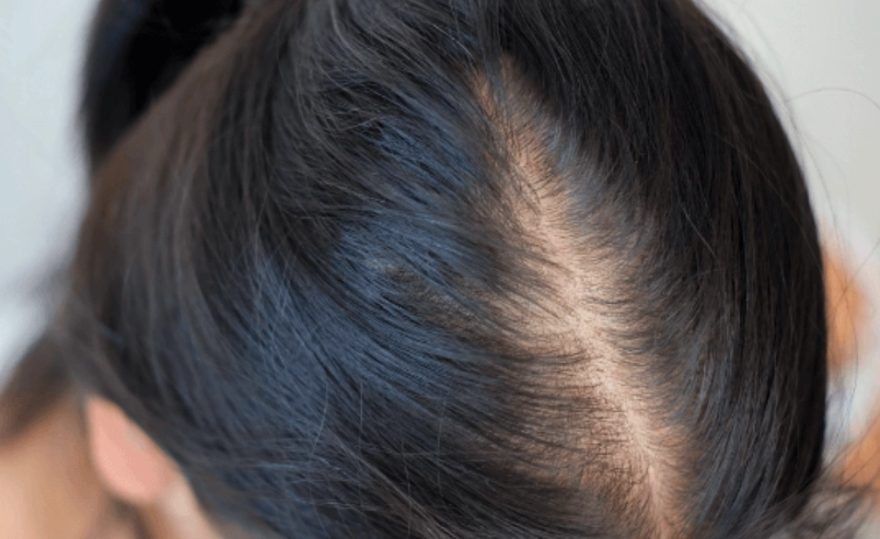 女生怎樣算禿頭？三大警訊與自我檢測方法全解析