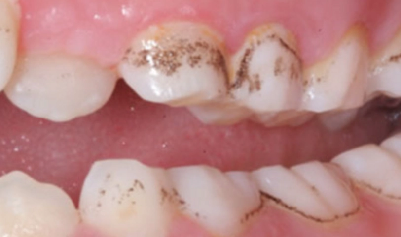 牙菌斑預防 牙菌斑預防