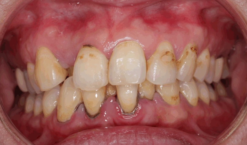 牙菌斑預防 牙菌斑預防