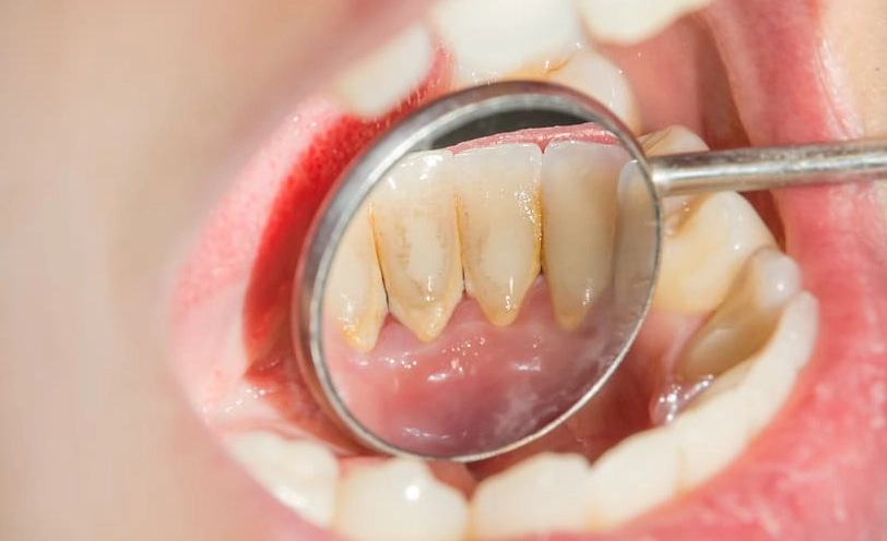 牙菌斑怎麼去除？牙醫師親授5招有效清除與預防方法