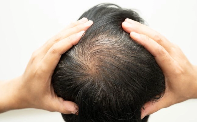 掉頭髮要吃什麼維他命？營養師教你用4大關鍵營養素找回豐盈秀髮