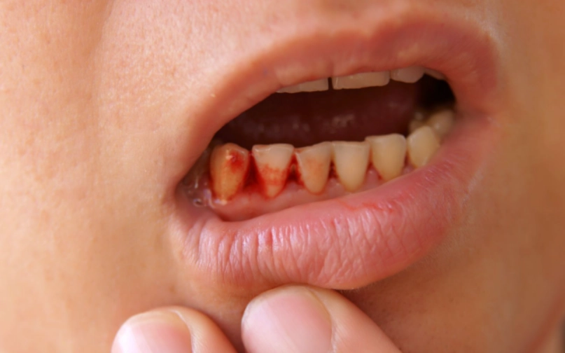 牙間刷流血正常嗎？專家教你正確清潔與預防方法