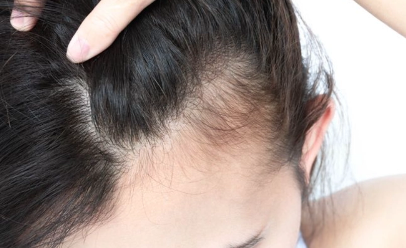 頭髮變細怎麼辦 頭髮變細怎麼辦