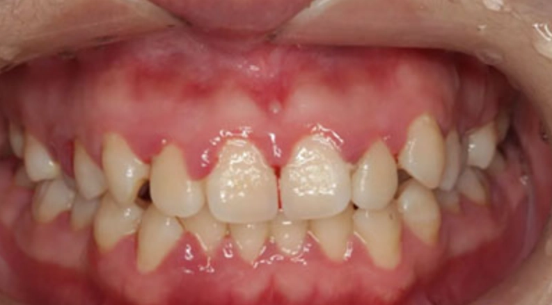 牙菌斑預防 牙菌斑預防