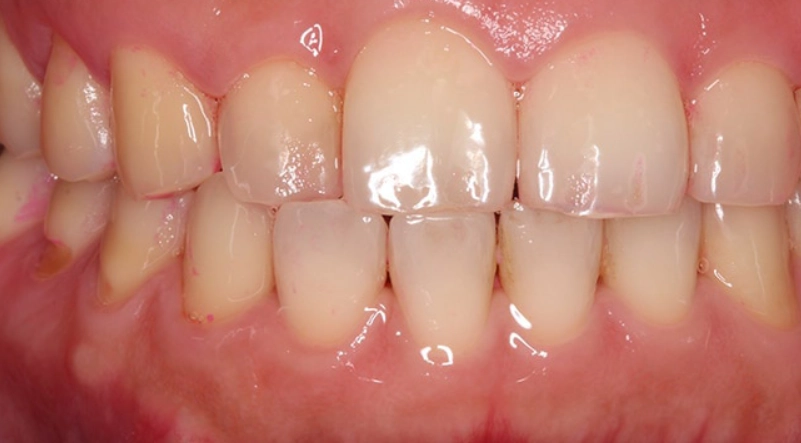 牙菌斑形成時間 牙菌斑形成時間