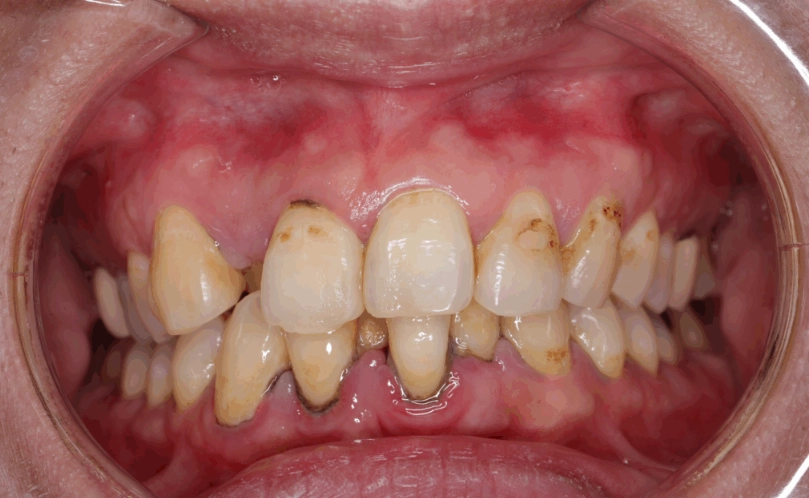 牙菌斑形成時間大公開：從無到有只需短短幾小時？