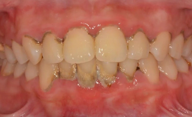 牙菌斑清除方法 牙菌斑清除方法