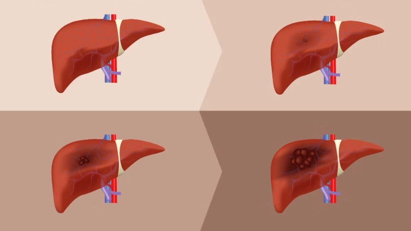 肝纖維化掃描 肝纖維化掃描