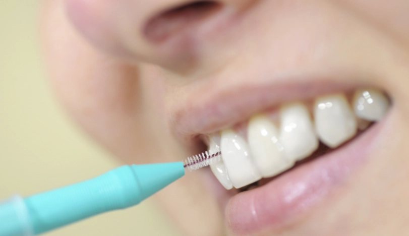 牙菌斑清除方法 牙菌斑清除方法