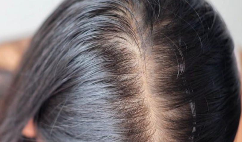 掉髮原因 掉髮原因