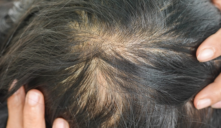 頭髮變細怎麼辦 頭髮變細怎麼辦