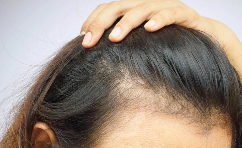 頭髮變細怎麼辦 頭髮變細怎麼辦