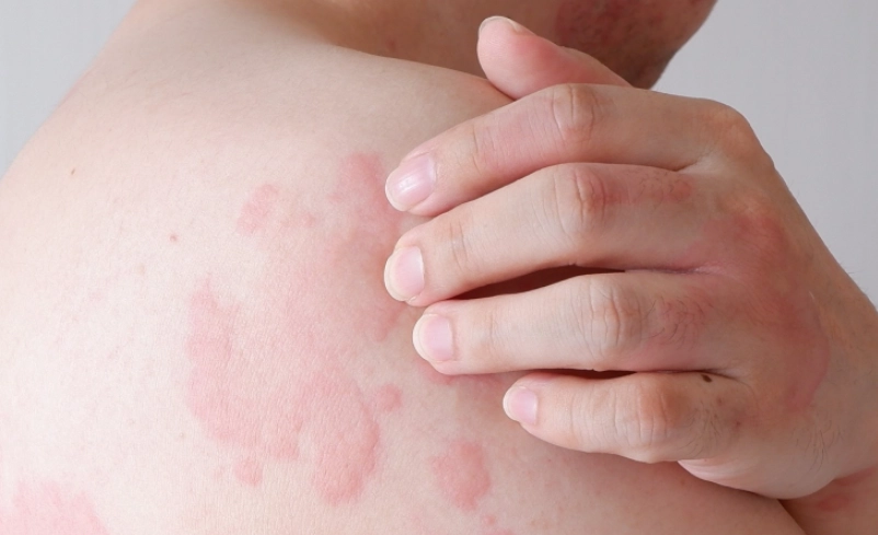 蕁麻疹不會癢是警訊？皮膚科醫師解析不癢蕁麻疹的真相與處置