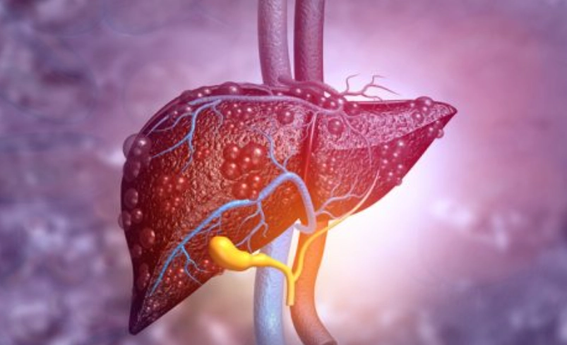 脂肪肝炎治療指南：逆轉肝臟發炎，從生活習慣開始
