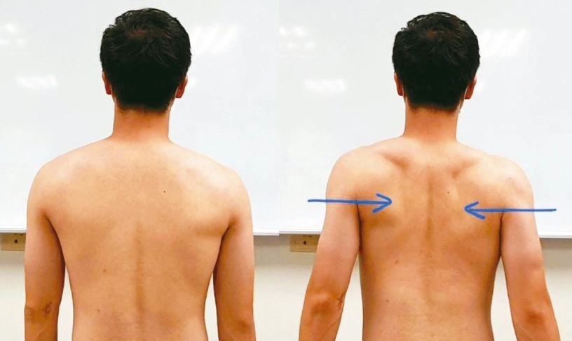 圓肩駝背物理治療：從根源改善姿勢的實戰指南