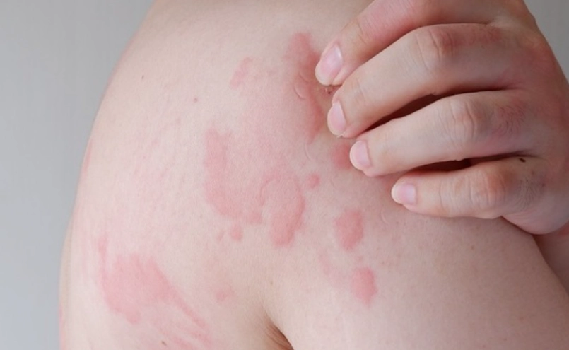 皮膚科醫師認證！蕁麻疹止癢全攻略，擺脫越抓越癢的惡性循環