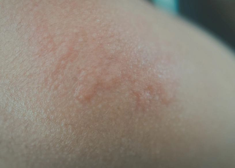 蕁麻疹發作怎麼辦？皮膚科醫師親授止癢與根治對策