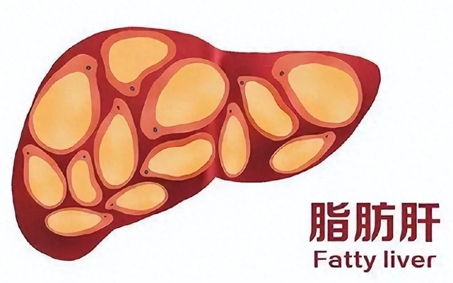 脂肪肝逆轉方法 脂肪肝逆轉方法