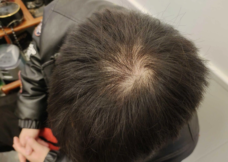 雄性禿