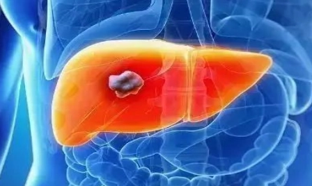 脂肪肝心血管疾病 脂肪肝心血管疾病
