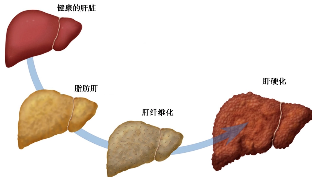 脂肪肝逆轉方法 脂肪肝逆轉方法
