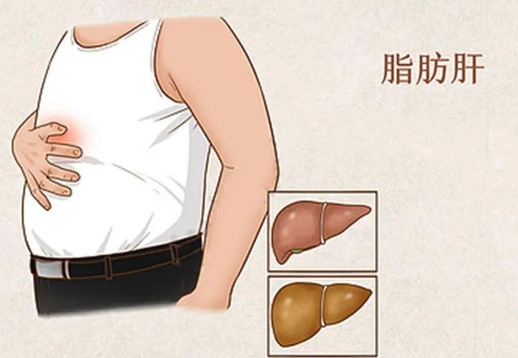脂肪肝逆轉方法 脂肪肝逆轉方法