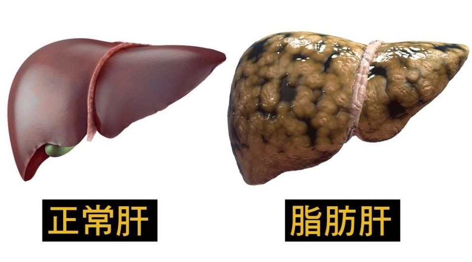 脂肪肝後遺症不只傷肝！心血管、糖尿病風險倍增的完整解析與逆轉指南