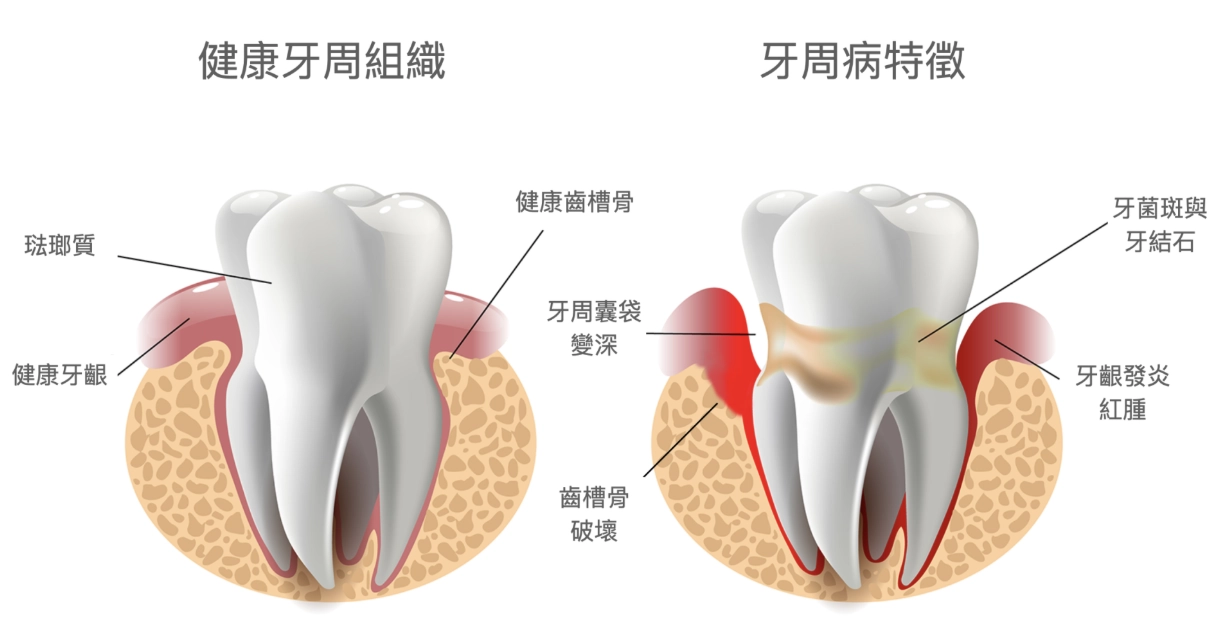 牙周病藥膏