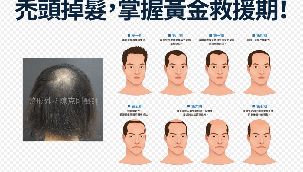 雄性禿初期 雄性禿初期