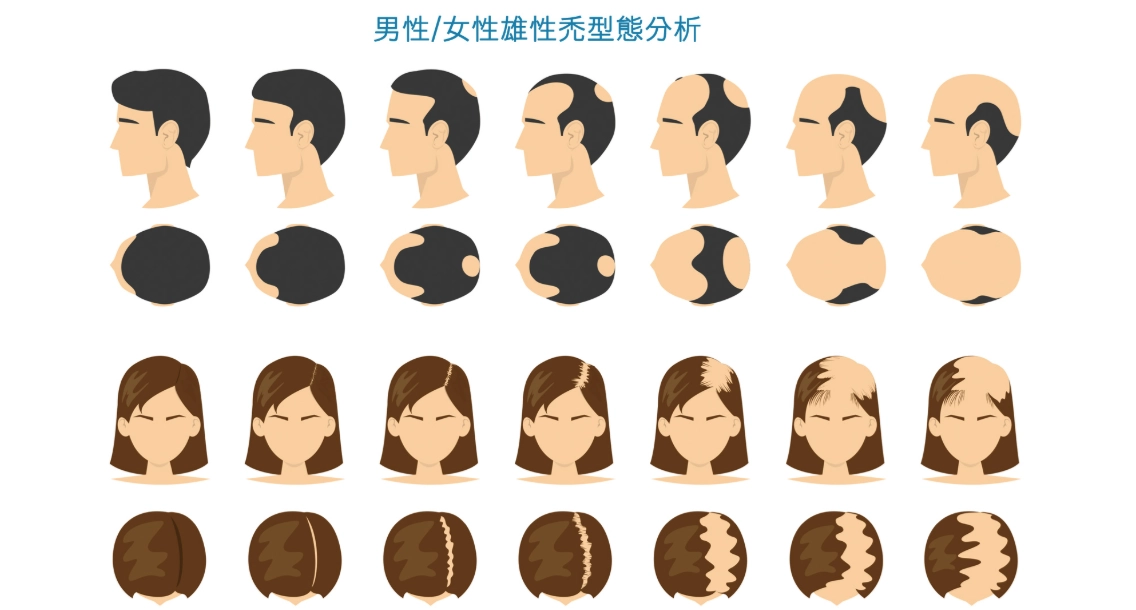 雄性禿會好嗎