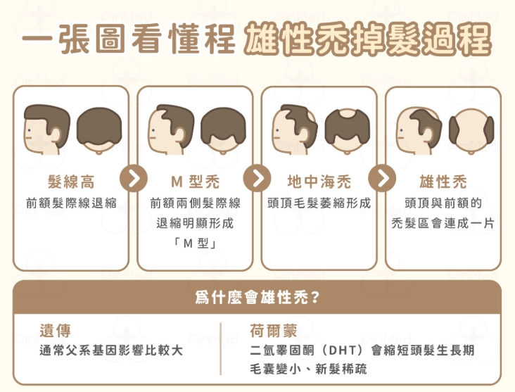 雄性禿治療 雄性禿治療