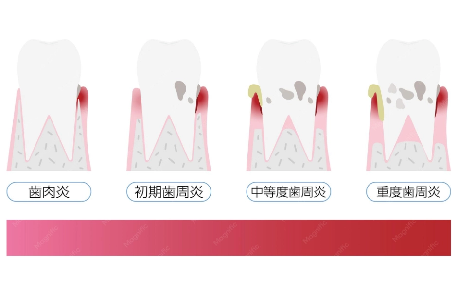 牙周雷射 牙周雷射