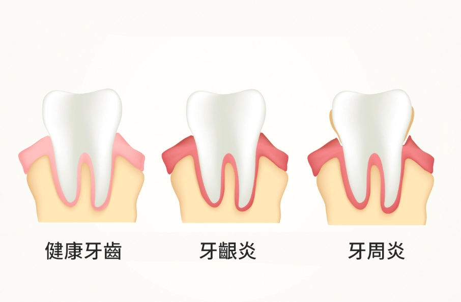 牙周病治療費用 牙周病治療費用
