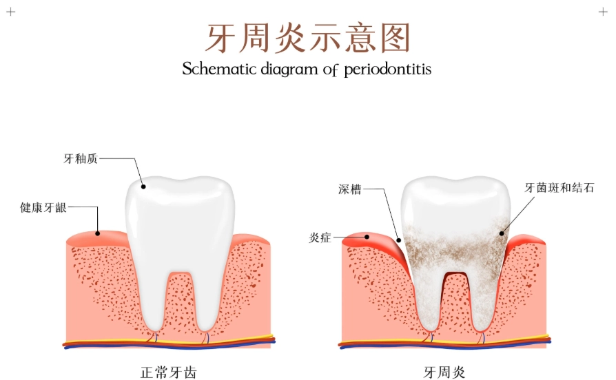 牙周病治療費用 牙周病治療費用