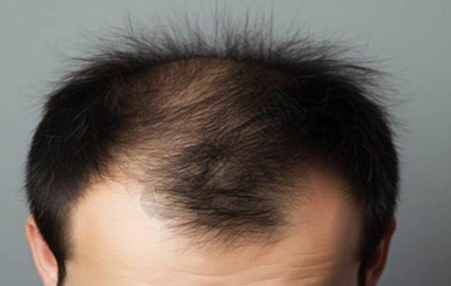 男性頭頂稀疏