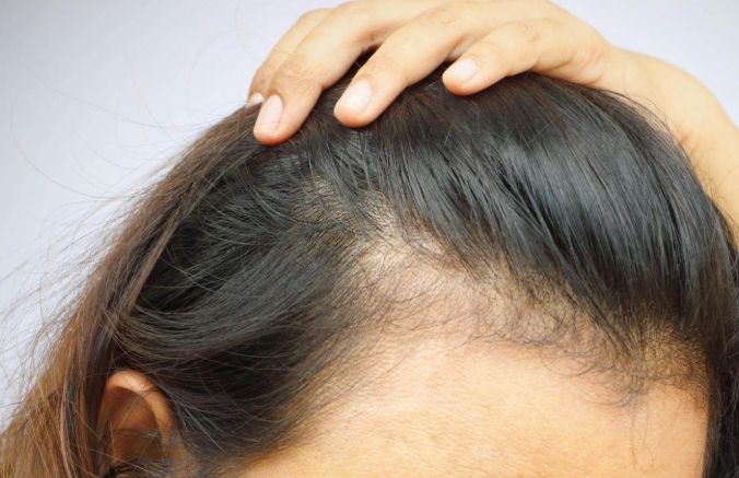 禿頭預防 禿頭預防