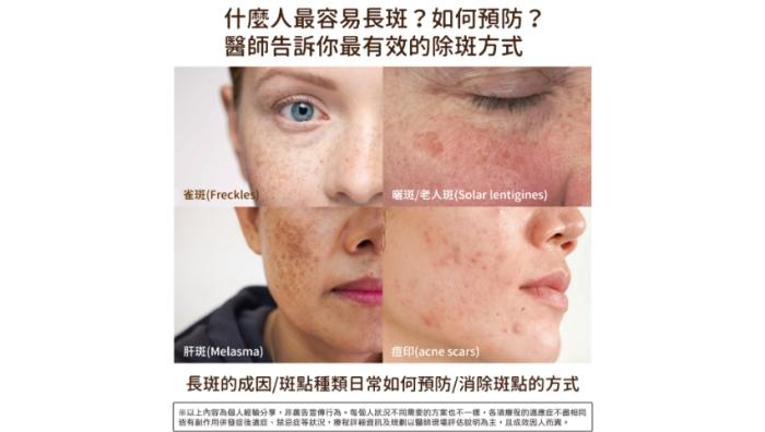 虎口色素沉着治療