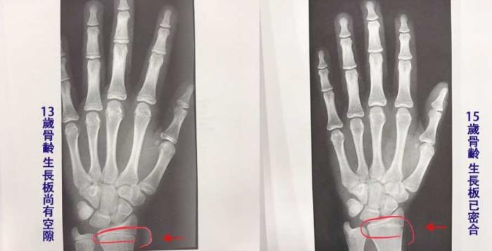 生長板閉合後長高方法