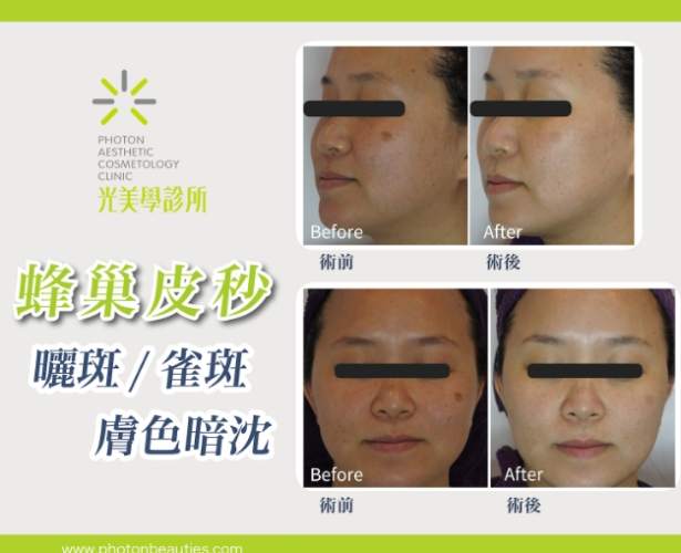 臉上黑斑變大原因