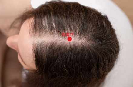 頭頂穴道痛治療 頭頂穴道痛治療