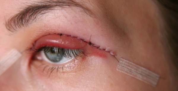 雙眼皮手術恢復 雙眼皮手術恢復