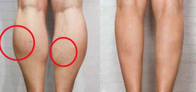 小腿粗壯改善 小腿粗壯改善